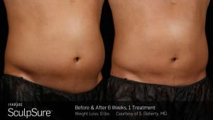 Sculpsure Before and After Photo of Male Torso